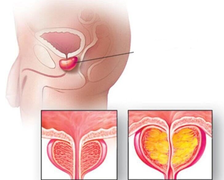 Location of the prostate, normal and enlarged prostate in chronic prostatitis