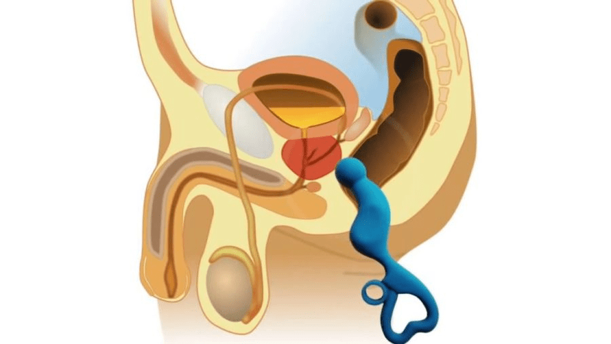 prostate massage for prostatitis treatment