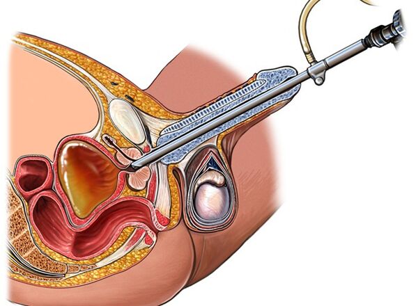 Prostatitis treatment