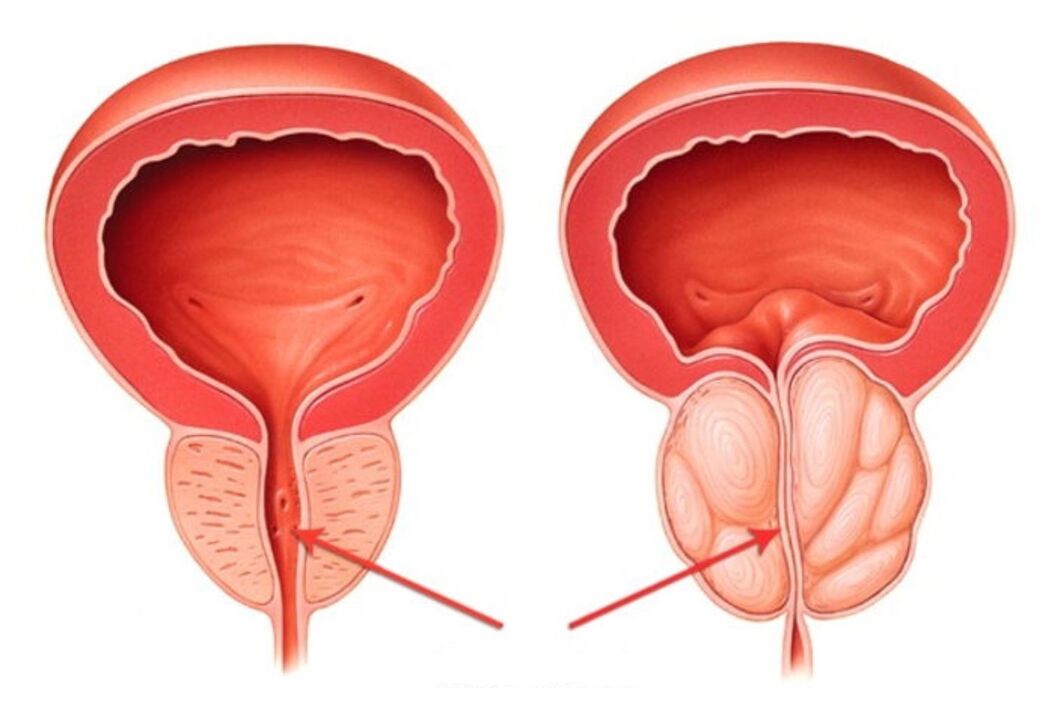healthy and inflamed prostate with prostatitis